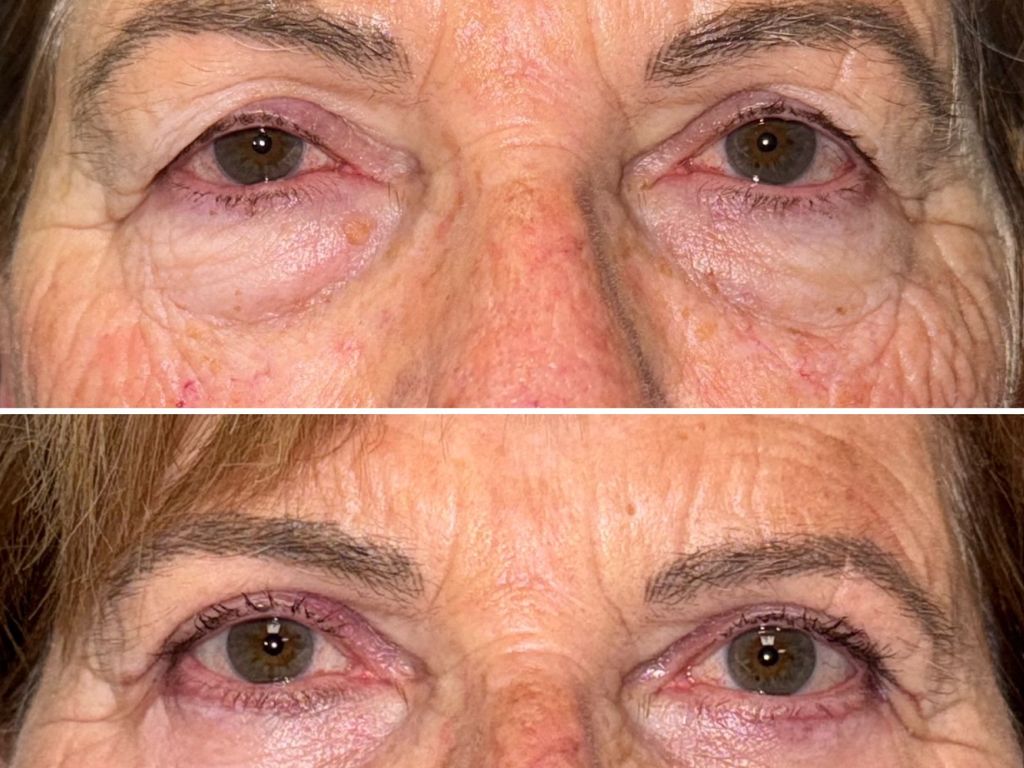 diferencias entre oculoplastia y blefaroplastia