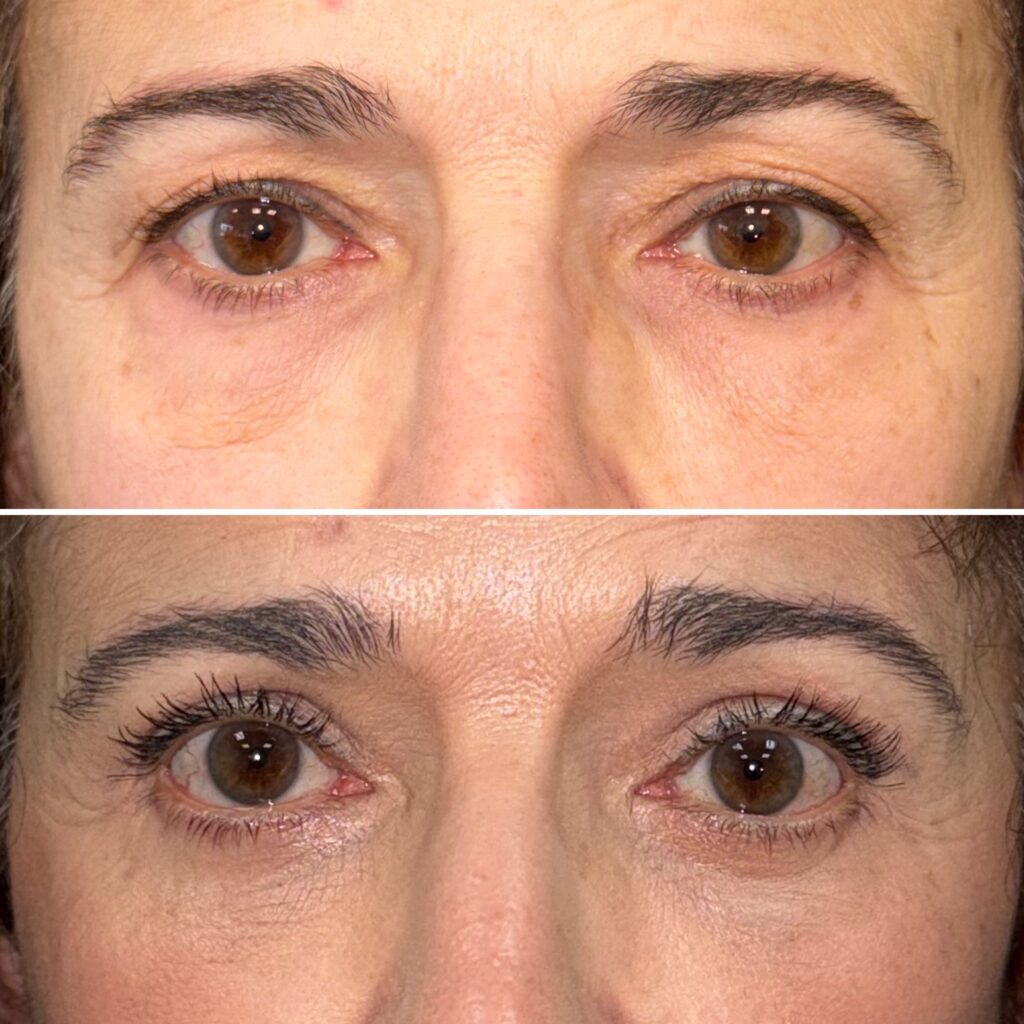 blefaroplastia superior en valencia blefaroplastia en valencia sonia penarrocha
